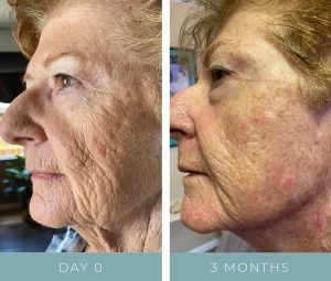 Before + After - Aging Face