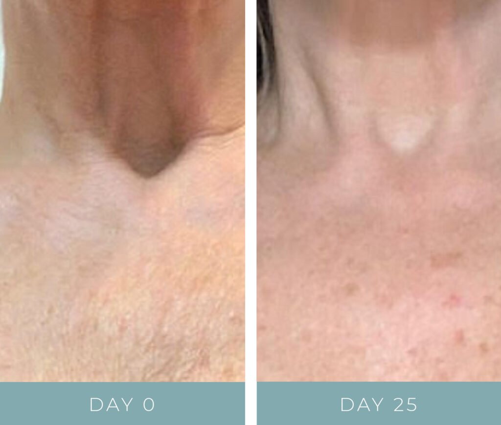 Before + After - Aging Neck