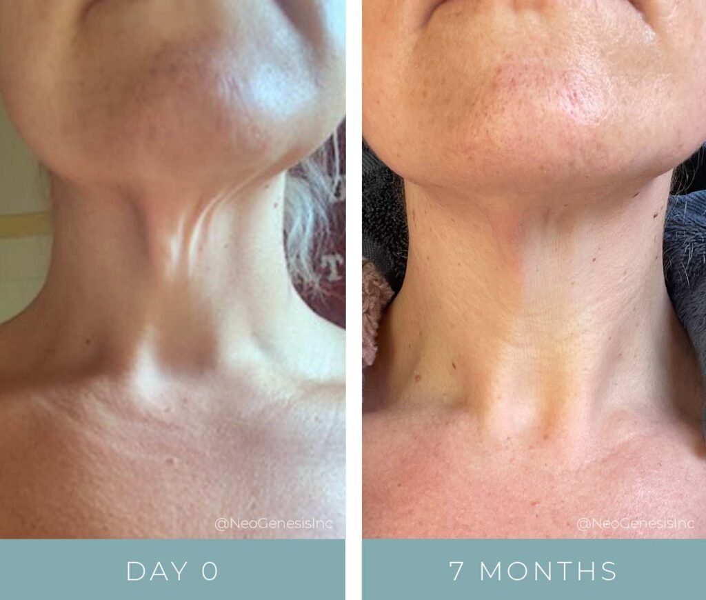 Before + After - Aging Neck