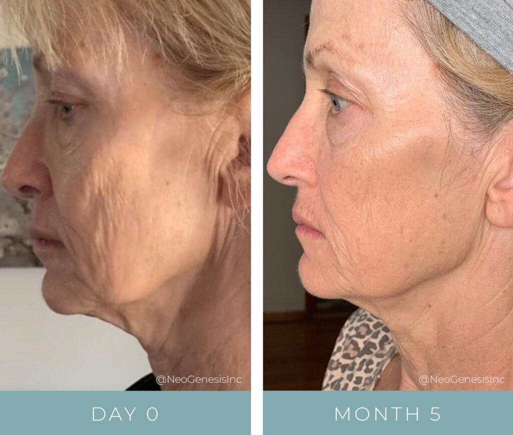 Before + After - Aging Skin