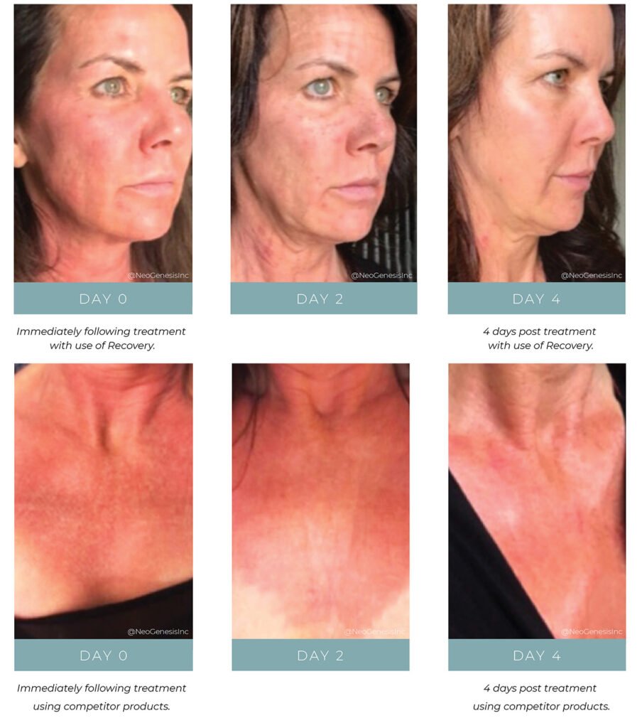 Before + After - C02 Laser - Product Comparison