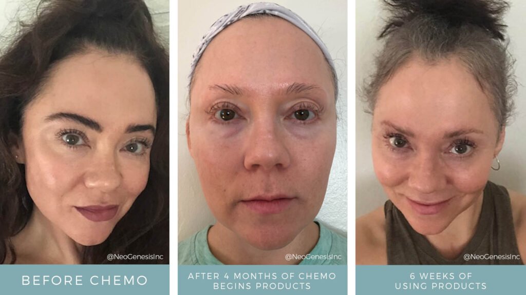 Before + After - Chemo - Hair + Lash + Brow Loss