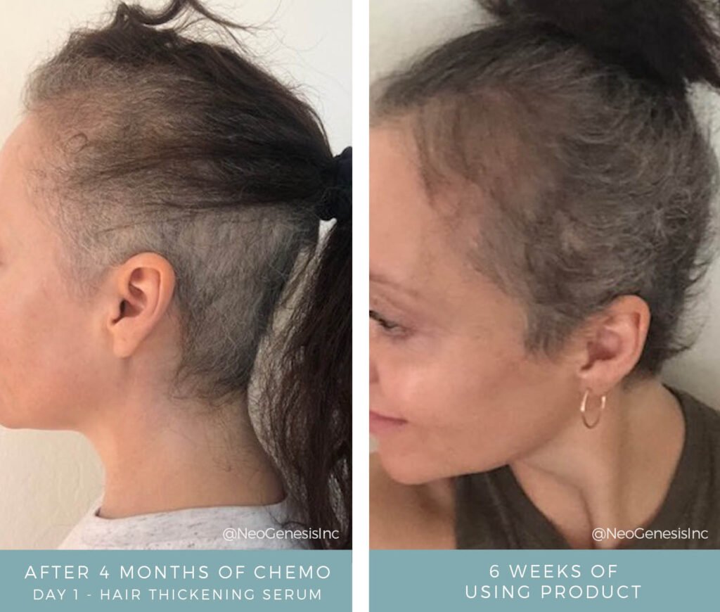 Before + After - Chemo Hair Loss