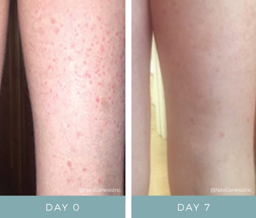 Before + After - Dermatitis