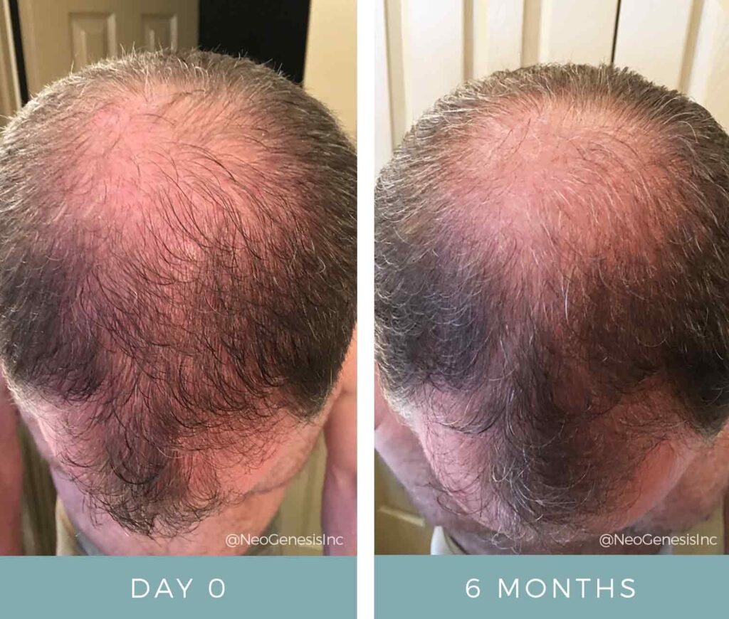 Before + After - Hair Loss