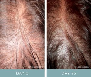 Before + After - Hair Loss Solutions