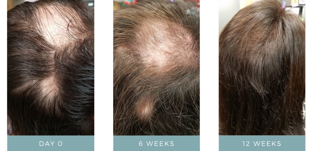 Hair Loss - Before + After Hair Thickening Serum