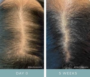 Hair Loss + Microneedling