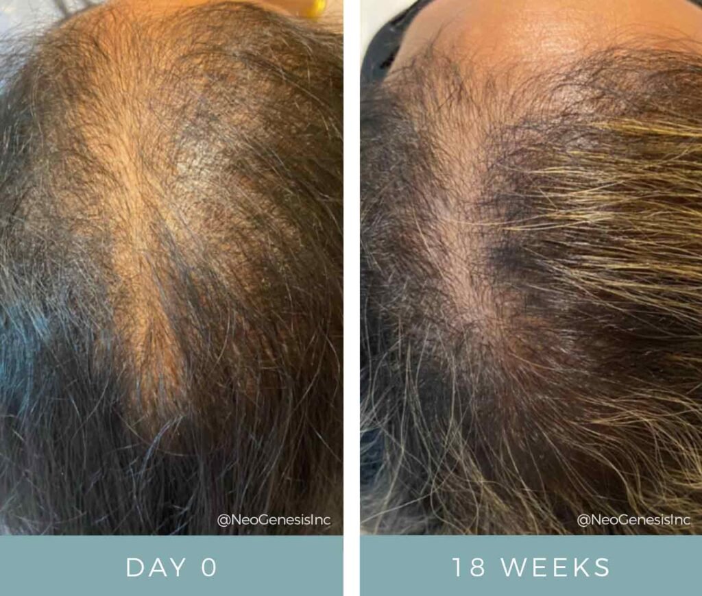 Hair Loss + Microneedling