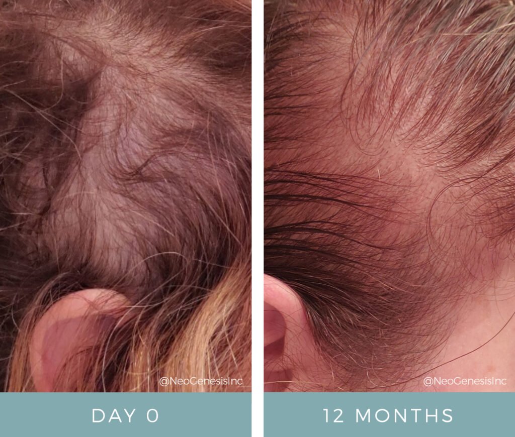 Before + After - Hair Loss Products for Women