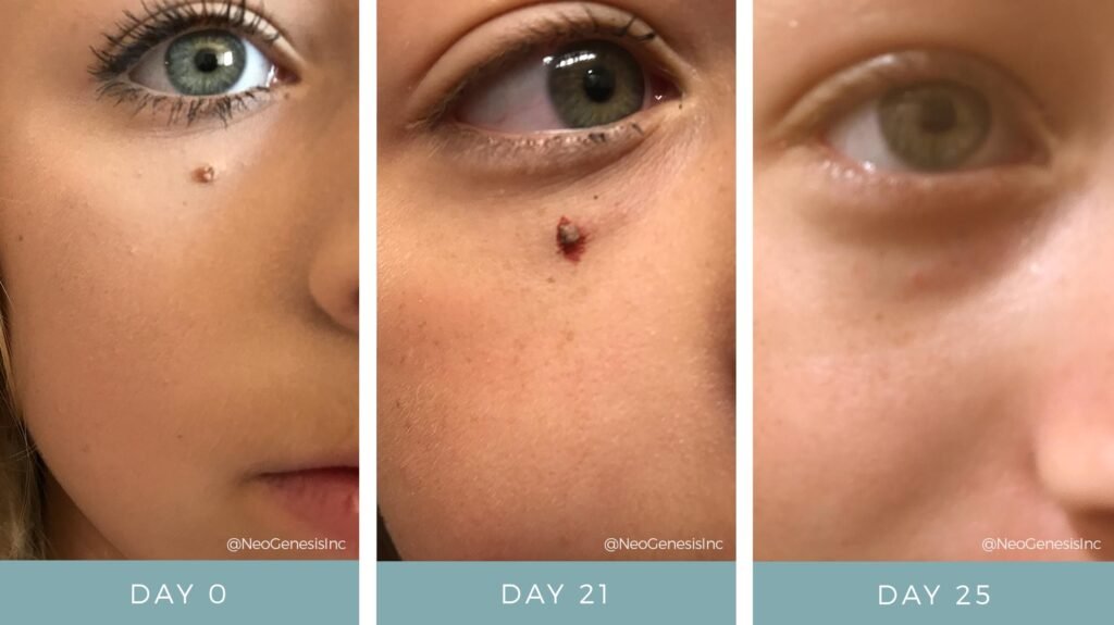 Before + After - Hyperkeratosis - NeoGenesis Recovery Serum