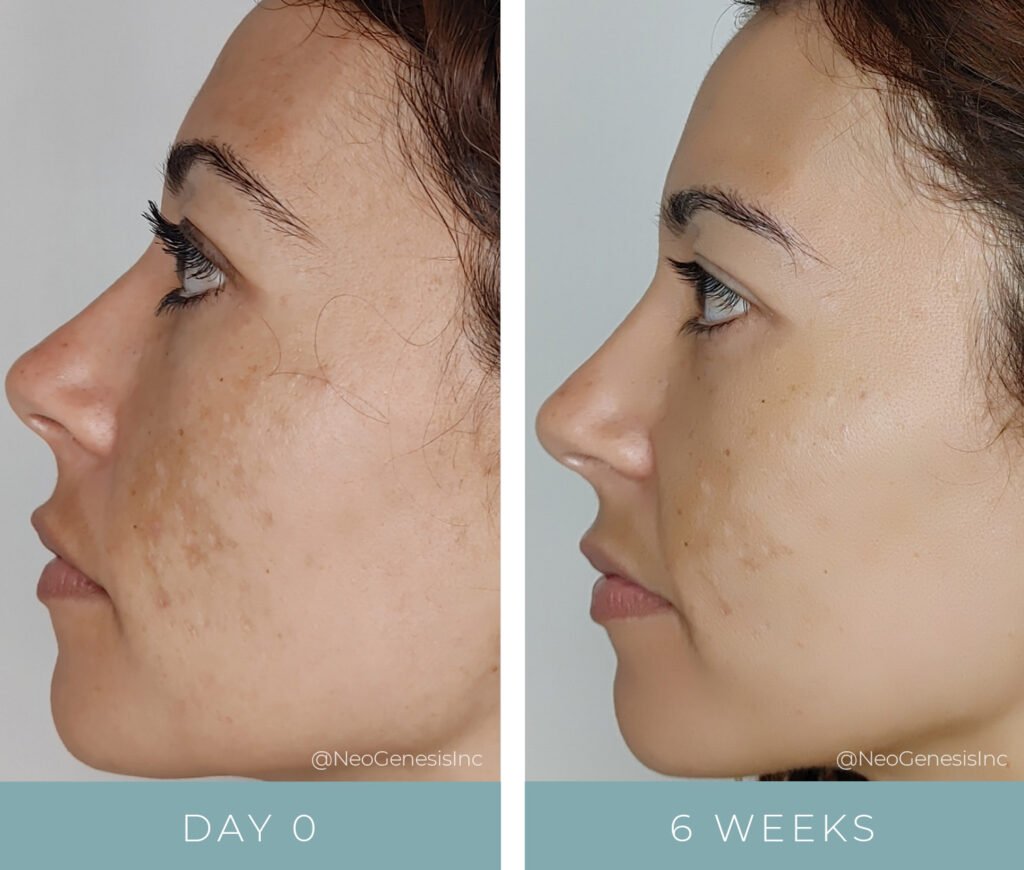 Before + After - Hyperpigmentation - Microneedling