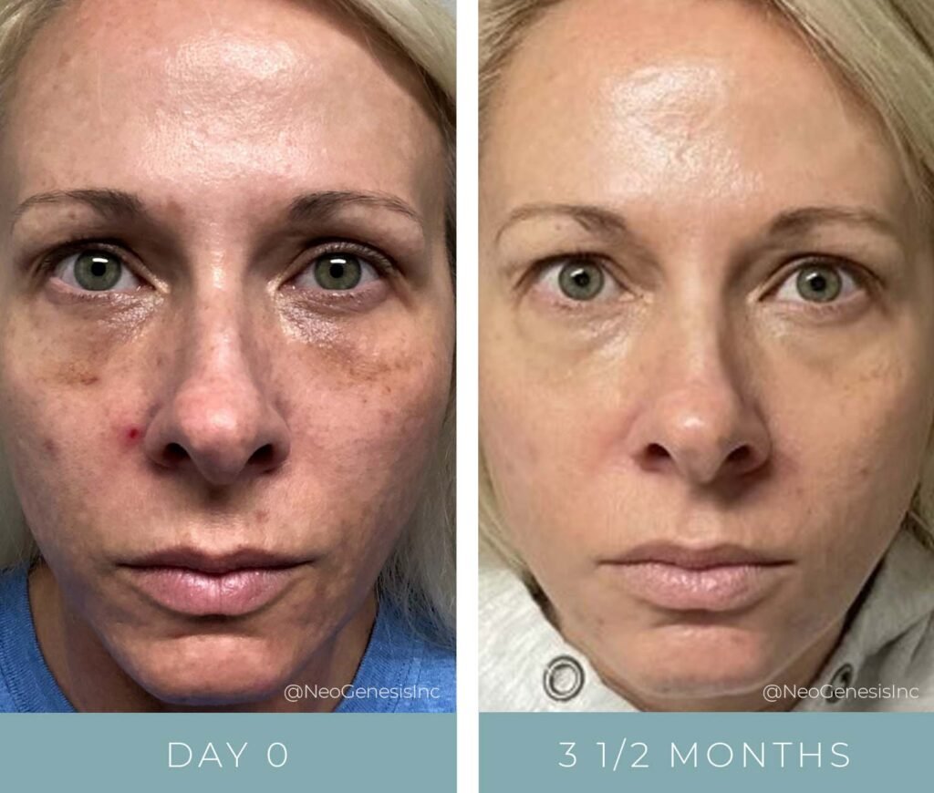 Before + After - Melasma