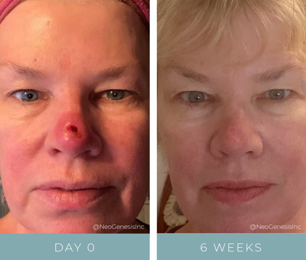 Mohs Surgery + Radiation - Before + After