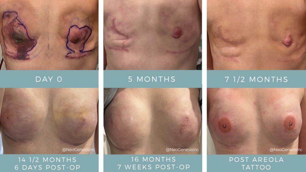 Double Mastectomy + Necrosis - Before + After