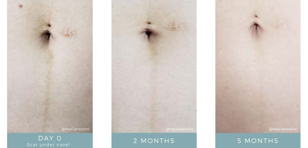 Before + After - Post-Pregnancy Scarring