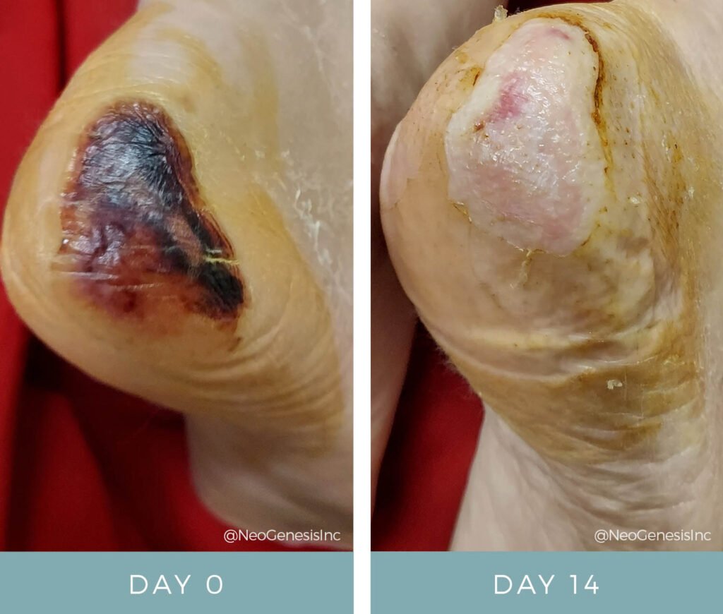 Before + After - Pressure Ulcer