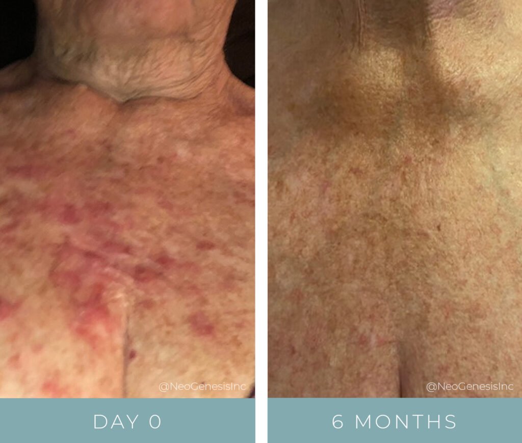 Before + After - Radiation Dermatitis