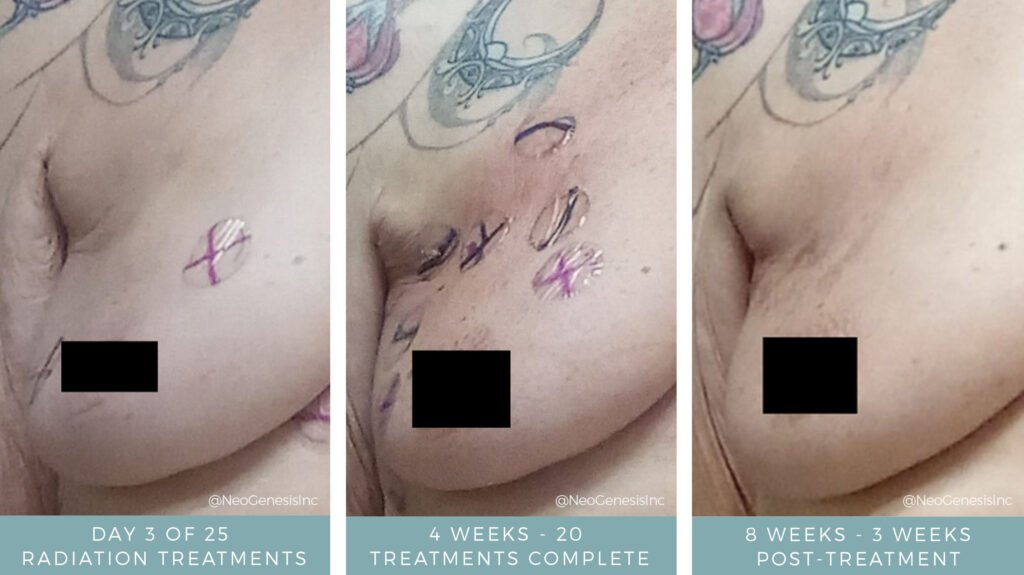 Before + After - Radiation for Breast Cancer