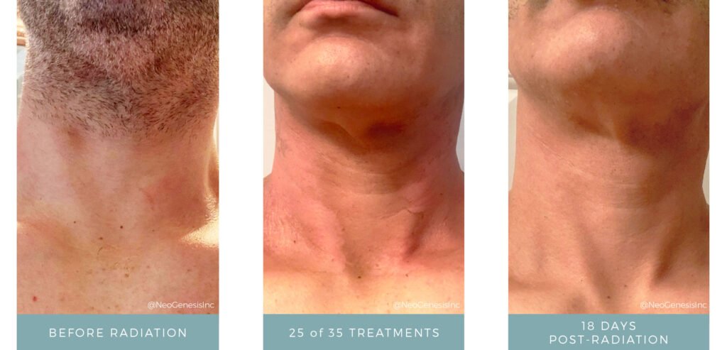 Before + After - Radiation - Head and Neck Cancer