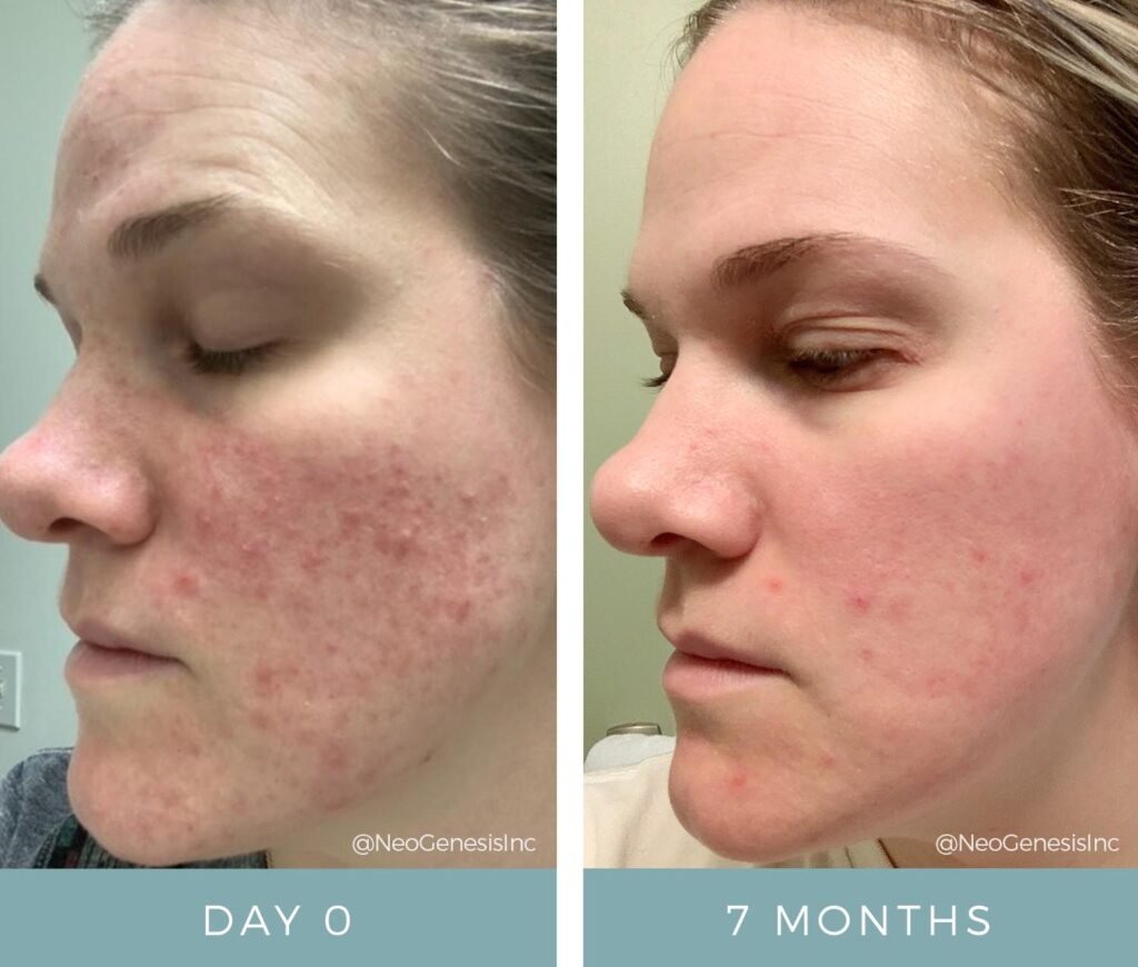 Rosacea - Before + After