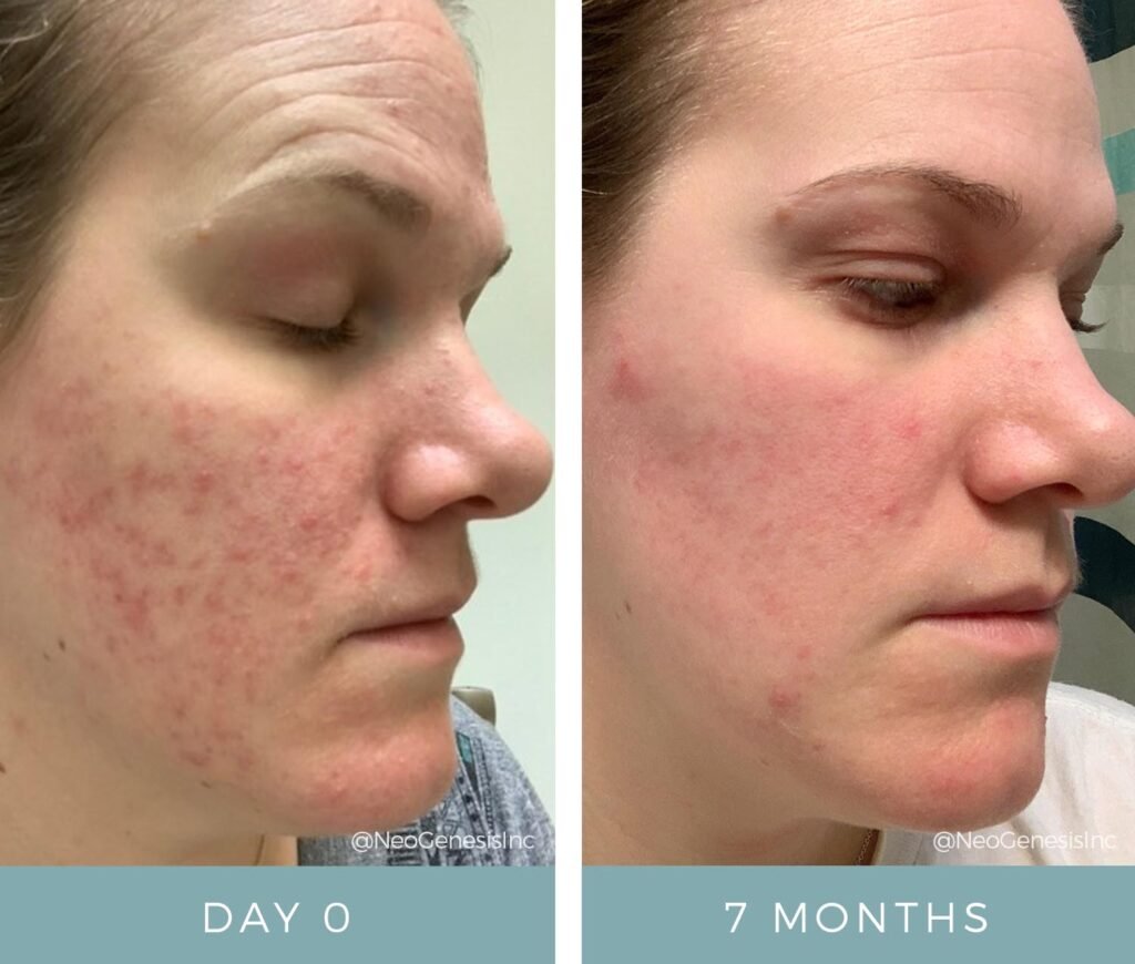 Rosacea - Before + After