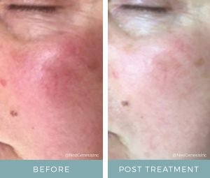 Before + After - Rosacea