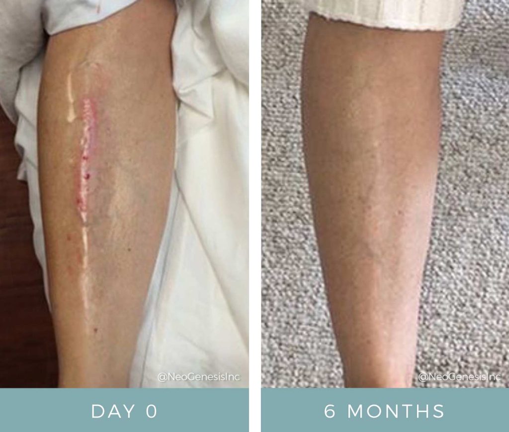 Wound Care + Scarring - Before + After NeoGenesis Recovery Serum