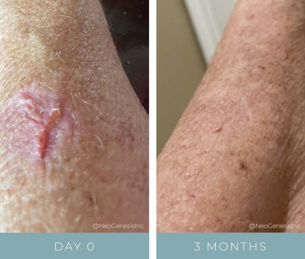 Before + After - Wound Care + Scarring