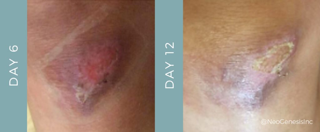 Before + After - Wound Care