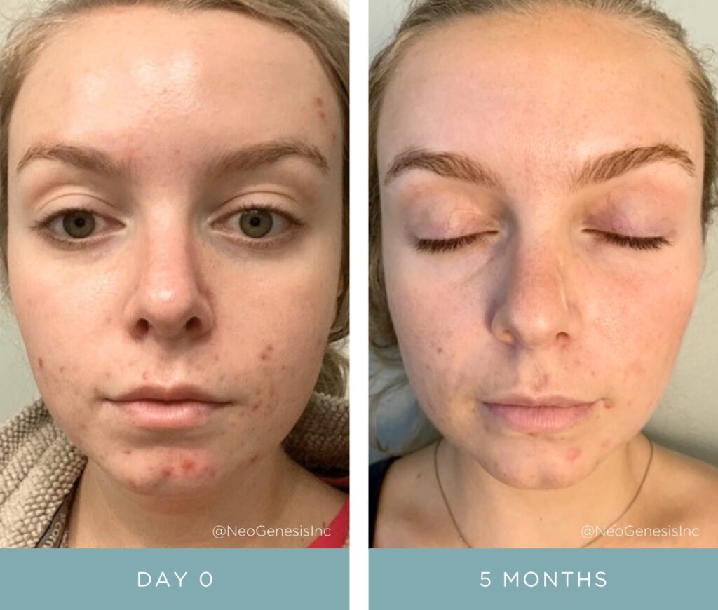 Before + After - Acne