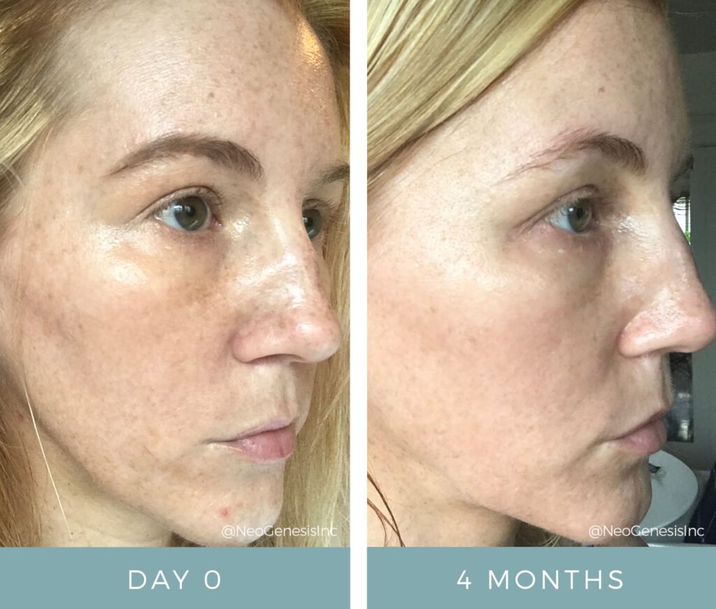 Before + After - Hyperpigmentation