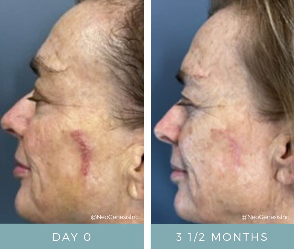 Before + After - Skin Cancer Surgery