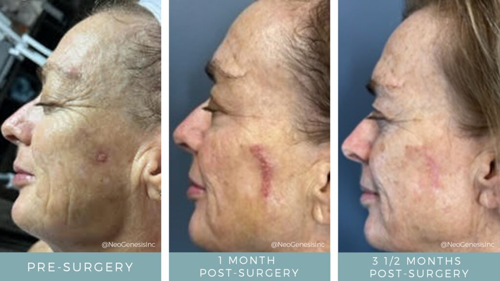 Before + After - Skin Cancer Surgery