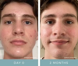 Before + After - Acne