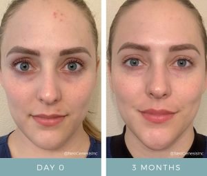 Acne from Stress and Wearing Masks