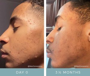 Before + After - Acne