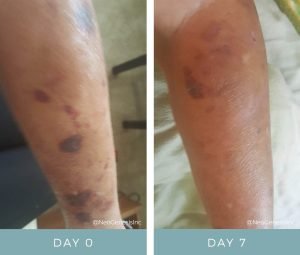 Before + After - Actinic Purpura