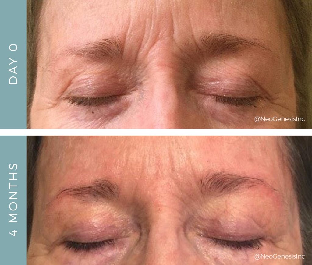 Aging Skin - Before + After NeoGenesis Skin Care Products