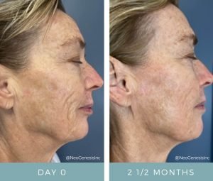 Aging + PIH + Melasma + Sun Damage + Skin Cancer Skin Issues