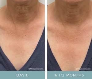 Aging Neck - Before + After Results