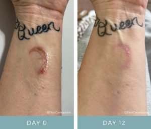 Burn - Before + After NeoGenesis Recovery Serum