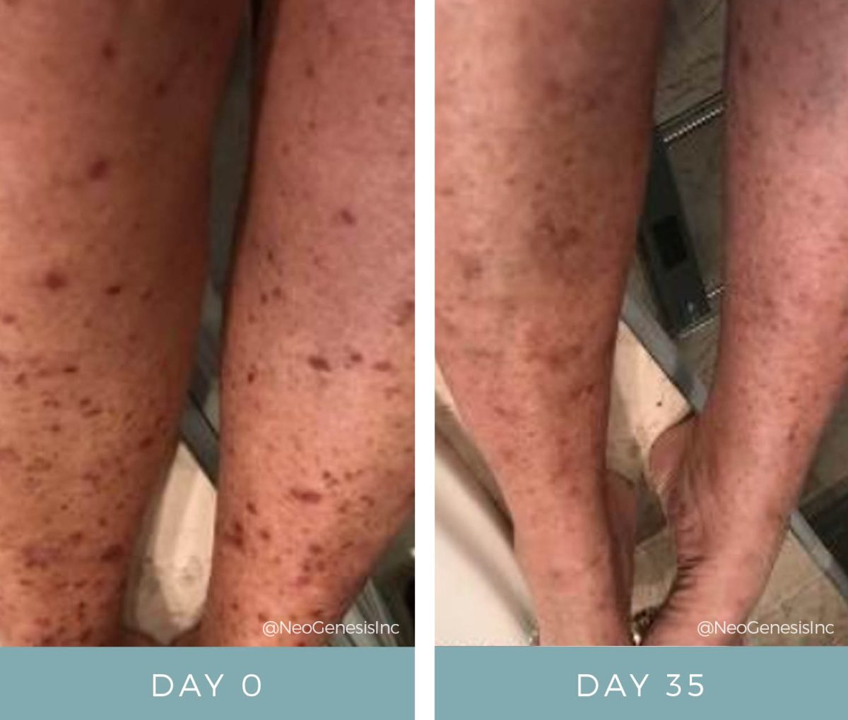 Chemotherapy Rash Before After Neogenesis Skin Care 