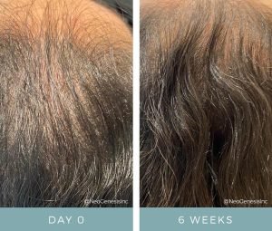 Hair Loss - Microneedling with NeoGenesis Hair Thickening Serum