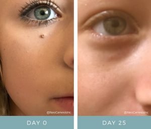 Hyperkeratosis - Before + After NeoGenesis Recovery Serum