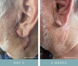 Post Cancer Surgery Scarring - Before + After