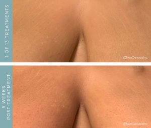 Before + After - Radiation - Breast Cancer