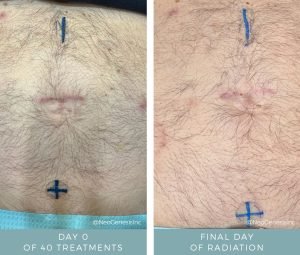 Radiation for Prostate Cancer - Before + After