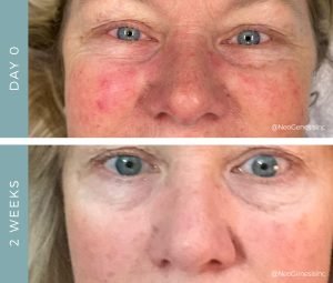 Rosacea - Before + After