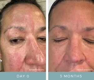 Rosacea + Seborrheic Dermatitis